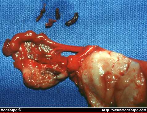 Multiple placental thrombi